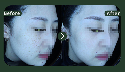 [주근깨] 30대 젼후사진