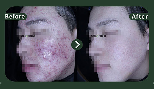 [여드름] 20대 전후사진
