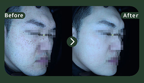 [잡티] 30대 전후사진