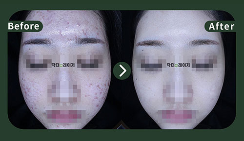 [여드름] 20대 전후사진