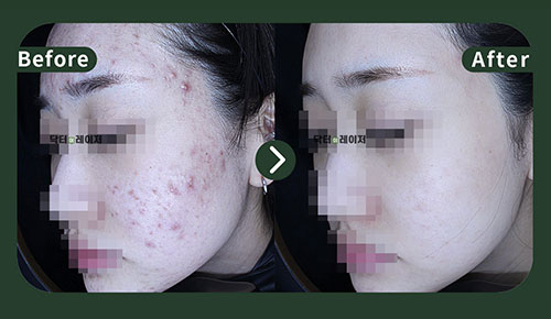 [여드름] 20대 전후사진