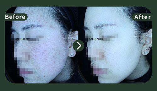 [여드름] 20대 전후사진