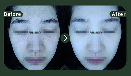 [주근깨]30대 젼후사진