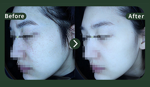 [주근깨]30대 젼후사진